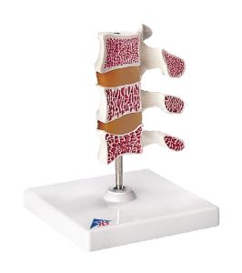3B Scientific® Deluxe Osteoporosis Model