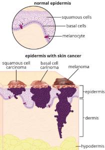 Science Take-Out® A Case Of Skin Cancer