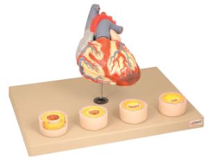 Eisco® Heart Pathologies Model