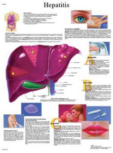3B Scientific® Hepatitis Chart