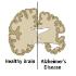 Alzheimer's disease vs healthy brain